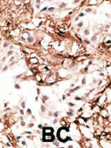 Formalin-fixed and paraffin-embedded human cancer tissue reacted with the primary antibody, which was peroxidase-conjugated to the secondary antibody, followed by AEC staining. This data demonstrates the use of this antibody for immunohistochemistry; clinical relevance has not been evaluated. BC = breast carcinoma; HC = hepatocarcinoma.