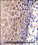 CCDC97 Antibody (C-term) (Cat. #AP50799PU-N)immunohistochemistry analysis in formalin fixed and paraffin embedded human esophageal carcinoma followed by peroxidase conjugation of the secondary antibody and DAB staining.This data demonstrates the use of CCDC97 Antibody (C-term) for immunohistochemistry.  Clinical relevance has not been evaluated.
