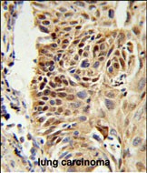 CIRBP Antibody (C-term) (Cat. #AP50926PU-N) IHC analysis in formalin fixed and paraffin embedded human lung carcinoma followed by peroxidase conjugation of the secondary antibody and DAB staining.  This data demonstrates the use of the CIRBP Antibody (C-term) for immunohistochemistry.  Clinical relevance has not been evaluated.