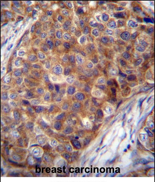 COX7A2L Antibody (Center) (Cat. #AP51037PU-N)immunohistochemistry analysis in formalin fixed and paraffin embedded human breast carcinoma followed by peroxidase conjugation of the secondary antibody and DAB staining.This data demonstrates the use of COX7A2L Antibody (Center) for immunohistochemistry.  Clinical relevance has not been evaluated.