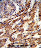 Formalin-fixed and paraffin-embedded human hepatocarcinoma reacted with ERGIC3 Antibody (N-term), which was peroxidase-conjugated to the secondary antibody, followed by DAB staining. This data demonstrates the use of this antibody for immunohistochemistry; clinical relevance has not been evaluated.