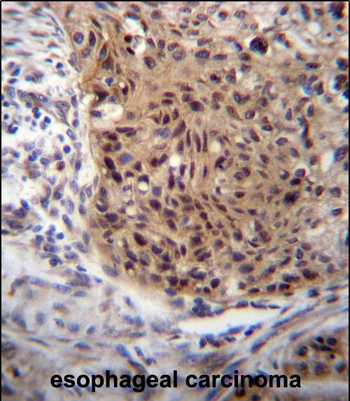 EXTL3 Antibody (N-term) (Cat. #AP51486PU-N)immunohistochemistry analysis in formalin fixed and paraffin embedded human esophageal carcinoma followed by peroxidase conjugation of the secondary antibody and DAB staining.This data demonstrates the use of EXTL3 Antibody (N-term) for immunohistochemistry.  Clinical relevance has not been evaluated.