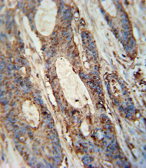 FAM46A antibody (Center) (Cat. #AP51579PU-N) immunohistochemistry analysis in formalin fixed and paraffin embedded human colon carcinoma followed by peroxidase conjugation of the secondary antibody and DAB staining.  This data demonstrates the use of the FAM46A antibody (Center) for immunohistochemistry.  Clinical relevance has not been evaluated.