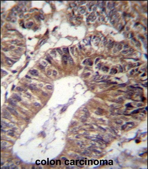 GCC1 Antibody (C-term) (Cat. #AP12984b)immunohistochemistry analysis in formalin fixed and paraffin embedded human colon carcinoma followed by peroxidase conjugation of the secondary antibody and DAB staining.This data demonstrates the use of GCC1 Antibody (C-term) for immunohistochemistry.  Clinical relevance has not been evaluated.