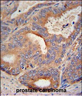 GLB1L2 antibody (C-term) (Cat. #AP51846PU-N) immunohistochemistry analysis in formalin fixed and paraffin embedded human prostate carcinoma followed by peroxidase conjugation of the secondary antibody and DAB staining.  This data demonstrates the use of the GLB1L2 antibody (C-term) for immunohistochemistry.  Clinical relevance has not been evaluated.
