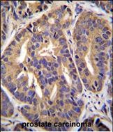 GTF2H2C Antibody (C-term) (Cat. #AP51972PU-N)immunohistochemistry analysis in formalin fixed and paraffin embedded human prostate carcinoma followed by peroxidase conjugation of the secondary antibody and DAB staining.This data demonstrates the use of GTF2H2C Antibody (C-term) for immunohistochemistry.  Clinical relevance has not been evaluated.
