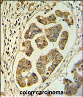 HCCS Antibody (Center) (Cat. #AP52011PU-N) IHC analysis in formalin fixed and paraffin embedded colon carcinoma followed by peroxidase conjugation of the secondary antibody and DAB staining.  This data demonstrates the use of the HCCS Antibody (Center) for immunohistochemistry.  Clinical relevance has not been evaluated.