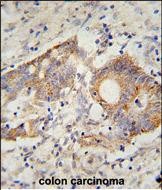 HHLA2 Antibody (N-term) (Cat. #AP52042PU-N) immunohistochemistry analysis in formalin fixed and paraffin embedded human colon carcinoma followed by peroxidase conjugation of the secondary antibody and DAB staining.  This data demonstrates the use of the HHLA2 Antibody (N-term) for immunohistochemistry.  Clinical relevance has not been evaluated.