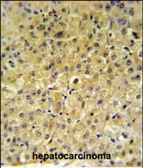 INSC Antibody (Center) (Cat. #AP52216PU-N) IHC analysis in formalin fixed and paraffin embedded hepatocarcinoma followed by peroxidase conjugation of the secondary antibody and DAB staining.  This data demonstrates the use of the INSC Antibody (Center) for immunohistochemistry.  Clinical relevance has not been evaluated.