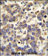 LYPD4 antibody (Center) (Cat. #AP10344c) immunohistochemistry analysis in formalin fixed and paraffin embedded human testis carcinoma followed by peroxidase conjugation of the secondary antibody and DAB staining.This data demonstrates the use of the LYPD4 antibody (Center) for immunohistochemistry.  Clinical relevance has not been evaluated.