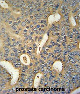 MICALL1 Antibody (C-term) (Cat. #AP52694PU-N) immunohistochemistry analysis in formalin fixed and paraffin embedded human prostate carcinoma followed by peroxidase conjugation of the secondary antibody and DAB staining.  This data demonstrates the use of the MICALL1 Antibody (C-term) for immunohistochemistry.  Clinical relevance has not been evaluated.