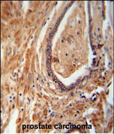 NDUFAF1 antibody (C-term) (Cat. #AP10745b) immunohistochemistry analysis in formalin fixed and paraffin embedded human prostate carcinoma followed by peroxidase conjugation of the secondary antibody and DAB staining.  This data demonstrates the use of the NDUFAF1 antibody (C-term) for immunohistochemistry.  Clinical relevance has not been evaluated.