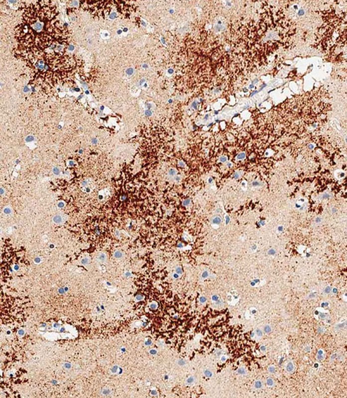 Immunohistochemical analysis of paraffin-embedded human brain tissue using AP53132PU-N performed on the Leica® BOND RXm. Tissue was fixed with formaldehyde at room temperature,  antigen retrieval was by heat mediation with a EDTA buffer (pH9. 0). Samples were incubated with primary antibody(1:500) for 1 hours at room temperature.  A undiluted biotinylated CRF Anti-Polyvalent HRP Polymer antibody was used as the secondary antibody.