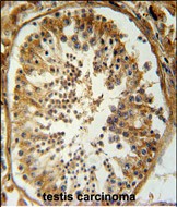 SRAC1 Antibody (C-term) (Cat. #AP54038PU-N) immunohistochemistry analysis in formalin fixed and paraffin embedded human testis carcinoma followed by peroxidase conjugation of the secondary antibody and DAB staining.  This data demonstrates the use of the SRAC1 Antibody (C-term) for immunohistochemistry.  Clinical relevance has not been evaluated.