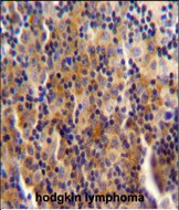 SYNE3 antibody (C-term) (Cat. #AP54124PU-N) immunohistochemistry analysis in formalin fixed and paraffin embedded human hodgkin lymphoma followed by peroxidase conjugation of the secondary antibody and DAB staining.This data demonstrates the use of SYNE3 antibody (C-term) for immunohistochemistry.  Clinical relevance has not been evaluated.