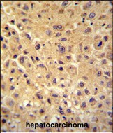 WBSCR27 antibody (N-term) (Cat. #AP54533PU-N) immunohistochemistry analysis in formalin fixed and paraffin embedded human hepatocarcinoma followed by peroxidase conjugation of the secondary antibody and DAB staining.  This data demonstrates the use of the WBSCR27 antibody (N-term) for immunohistochemistry.  Clinical relevance has not been evaluated.