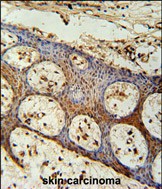 ZC3H3 Antibody (C-term) (Cat. #AP54622PU-N) immunohistochemistry analysis in formalin fixed and paraffin embedded human skin carcinoma followed by peroxidase conjugation of the secondary antibody and DAB staining.  This data demonstrates the use of the ZC3H3 Antibody (C-term) for immunohistochemistry.  Clinical relevance has not been evaluated.