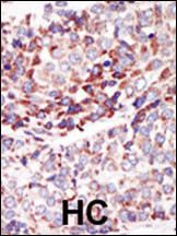 Formalin-fixed and paraffin-embedded human cancer tissue reacted with the primary antibody, which was peroxidase-conjugated to the secondary antibody, followed by AEC staining. This data demonstrates the use of this antibody for immunohistochemistry; clinical relevance has not been evaluated. BC = breast carcinoma; HC = hepatocarcinoma.