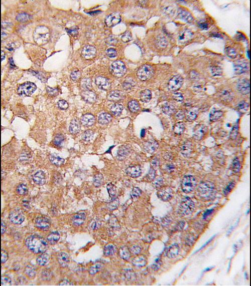 Formalin-fixed and paraffin-embedded human breast carcinoma tissue reacted with SNK Antibody (C-term ) (Cat.#TA302069), which was peroxidase-conjugated to the secondary antibody, followed by DAB staining. This data demonstrates the use of this antibody for immunohistochemistry; clinical relevance has not been evaluated.