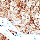 Formalin-fixed and paraffin-embedded human cancer tissue reacted with the primary antibody, which was peroxidase-conjugated to the secondary antibody, followed by AEC staining. This data demonstrates the use of this antibody for immunohistochemistry; clinical relevance has not been evaluated. BC = breast carcinoma; HC = hepatocarcinoma.