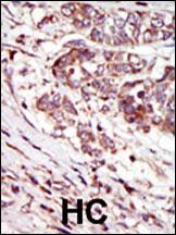 Formalin-fixed and paraffin-embedded human cancer tissue reacted with the primary antibody, which was peroxidase-conjugated to the secondary antibody, followed by AEC staining. This data demonstrates the use of this antibody for immunohistochemistry; clinical relevance has not been evaluated. BC = breast carcinoma; HC = hepatocarcinoma.