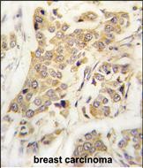 Formalin-fixed and paraffin-embedded human breast carcinoma tissue reacted with CDH8 antibody (N-term) (Cat.#TA302196), which was peroxidase-conjugated to the secondary antibody, followed by DAB staining. This data demonstrates the use of this antibody for immunohistochemistry; clinical relevance has not been evaluated.