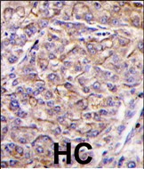 Formalin-fixed and paraffin-embedded human hepatocarcinoma tissue reacted with TAOK3 antibody (C-term)(Cat.#TA302258), which was peroxidase-conjugated to the secondary antibody, followed by DAB staining. This data demonstrates the use of this antibody for immunohistochemistry; clinical relevance has not been evaluated.