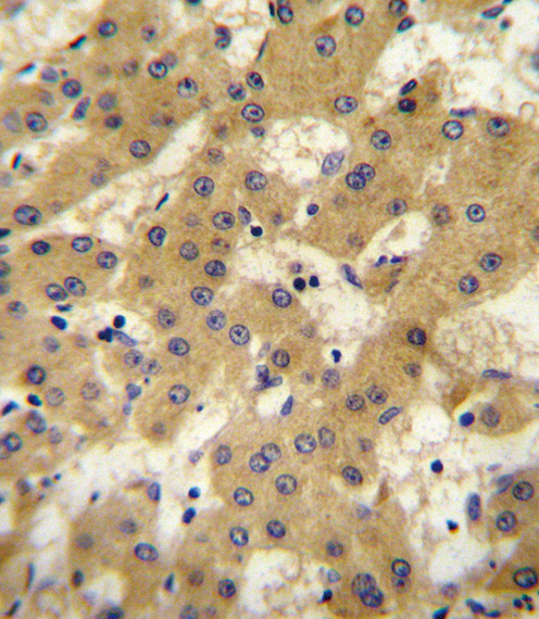 APOF antibody (Center) (Cat. #TA324356) immunohistochemistry analysis in formalin fixed and paraffin embedded human hepatocarcinoma followed by peroxidase conjugation of the secondary antibody and DAB staining.This data demonstrates the use of the APOF antibody (Center) for immunohistochemistry.  Clinical relevance has not been evaluated.