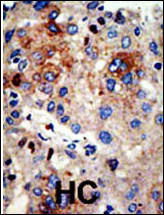Formalin-fixed and paraffin-embedded human cancer tissue reacted with the primary antibody, which was peroxidase-conjugated to the secondary antibody, followed by AEC staining. This data demonstrates the use of this antibody for immunohistochemistry; clinical relevance has not been evaluated. BC = breast carcinoma; HC = hepatocarcinoma.