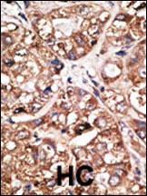 Formalin-fixed and paraffin-embedded human cancer tissue reacted with the primary antibody, which was peroxidase-conjugated to the secondary antibody, followed by DAB staining. This data demonstrates the use of this antibody for immunohistochemistry; clinical relevance has not been evaluated. BC = breast carcinoma; HC = hepatocarcinoma.