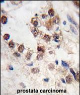 Formalin-fixed and paraffin-embedded human prostata carcinoma tissue reacted with KLF4 antibody (N-term C74) (Cat.#TA324722), which was peroxidase-conjugated to the secondary antibody, followed by DAB staining. This data demonstrates the use of this antibody for immunohistochemistry; clinical relevance has not been evaluated.