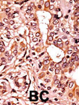 Formalin-fixed and paraffin-embedded human cancer tissue reacted with the primary antibody, which was peroxidase-conjugated to the secondary antibody, followed by AEC staining. This data demonstrates the use of this antibody for immunohistochemistry; clinical relevance has not been evaluated. BC = breast carcinoma; HC = hepatocarcinoma.
