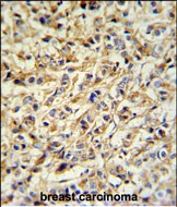 PRELP Antibody (Center) (Cat. #AP6665c) IHC analysis in formalin fixed and paraffin embedded breast carcinoma followed by peroxidase conjugation of the secondary antibody and DAB staining.  This data demonstrates the use of the PRELP Antibody (Center) for immunohistochemistry.  Clinical relevance has not been evaluated.