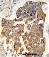 Formalin-fixed and paraffin-embedded human lung carcinoma tissue reacted with CASP9 antibody (Center) (Cat. #TA325012), which was peroxidase-conjugated to the secondary antibody, followed by DAB staining. This data demonstrates the use of this antibody for immunohistochemistry; clinical relevance has not been evaluated.