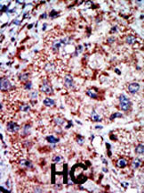 Formalin-fixed and paraffin-embedded human cancer tissue reacted with the primary antibody, which was peroxidase-conjugated to the secondary antibody, followed by AEC staining. This data demonstrates the use of this antibody for immunohistochemistry; clinical relevance has not been evaluated. BC = breast carcinoma; HC = hepatocarcinoma.