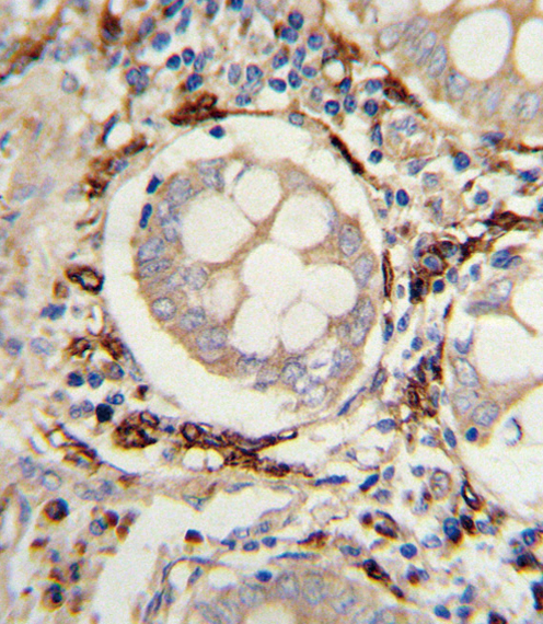 Formalin-fixed and paraffin-embedded human colon carcinoma with AOC3 Antibody (Center), which was peroxidase-conjugated to the secondary antibody, followed by DAB staining. This data demonstrates the use of this antibody for immunohistochemistry; clinical relevance has not been evaluated.