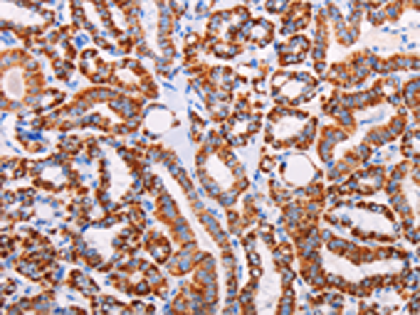 Immunohistochemistry of paraffin-embedded Human thyroid cancer tissue using TA321179 (AGTR2 Antibody) at dilution 1/15 (Original magnification: ×200)