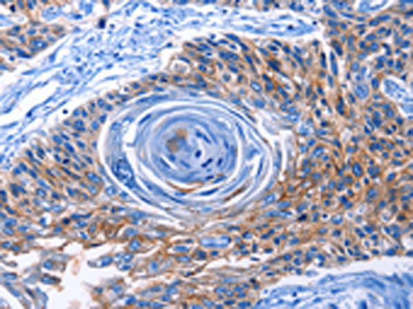 Immunohistochemistry of paraffin-embedded Human esophagus cancer tissue using TA322665 (CLEC2B Antibody) at dilution 1/50 (Original magnification: ×200)
