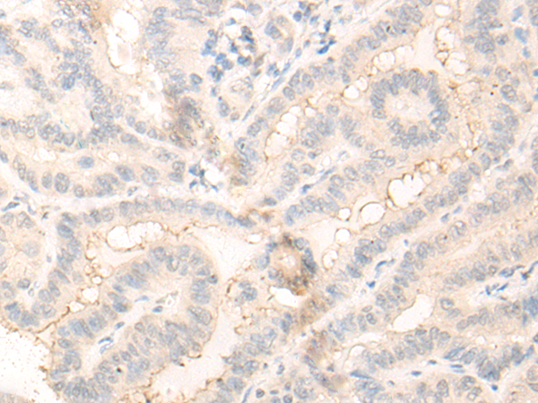 Immunohistochemistry of paraffin-embedded Human thyroid cancer tissue using TA365813 (RADIL Antibody) at dilution 1/30 (Original magnification: ×200)