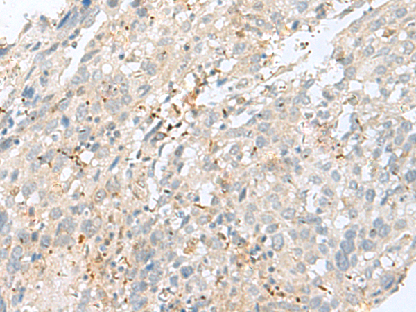 Immunohistochemistry of paraffin-embedded Human cervical cancer tissue using TA365984 (TPMT Antibody) at dilution 1/60 (Original magnification: ×200)