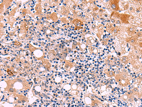 Immunohistochemistry of paraffin-embedded Human liver cancer tissue using TA366297 (KATNAL1 Antibody) at dilution 1/80 (Original magnification: ×200)
