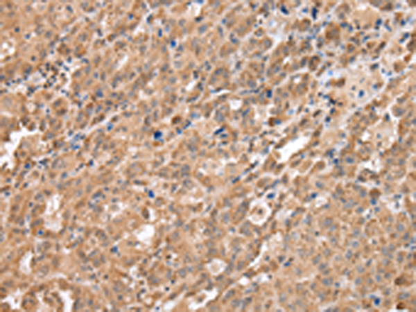 Immunohistochemistry of paraffin-embedded Human ovarian cancer tissue using TA367445 (DDX58 Antibody) at dilution 1/40 (Original magnification: ×200)