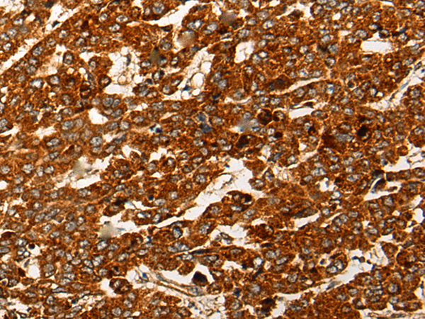 Immunohistochemistry of paraffin-embedded Human liver cancer tissue using TA367983 (CNTLN Antibody) at dilution 1/25 (Original magnification: ×200)