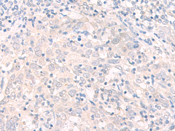 Immunohistochemistry of paraffin-embedded Human cervical cancer tissue using TA368261 (IL17B Antibody) at dilution 1/20 (Original magnification: ×200)