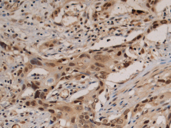 Immunohistochemistry of paraffin-embedded Human esophagus cancer tissue using TA370900 (KLF12 Antibody) at dilution 1/90 (Original magnification: ×200)