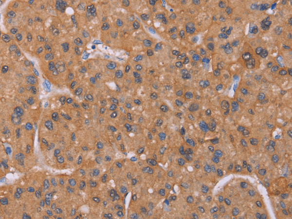 Immunohistochemistry of paraffin-embedded Human liver cancer tissue using TA371103 (CALCA/CALCB Antibody) at dilution 1/25 (Original magnification: ×200)