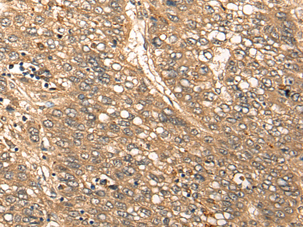 Immunohistochemistry of paraffin-embedded Human liver cancer tissue using TA372209 (CDRT15L2 Antibody) at dilution 1/20 (Original magnification: ×200)