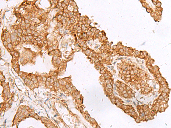 Immunohistochemistry of paraffin-embedded Human thyroid cancer tissue using TA372541 (FAM200A Antibody) at dilution 1/45 (Original magnification: ×200)