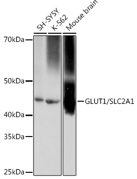 Immunohistochemistry analysis of paraffin-embedded Human lung squamous carcinoma tissue using GLUT1/SLC2A1 Rabbit mAb (TA425875) at a dilution of 1:800 (40x lens). High pressure antigen retrieval performed with 0.01M Tris-EDTA Buffer (pH 9.0) prior to IHC staining.