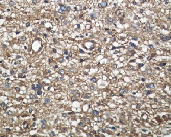 Immunohistochemical analysis of paraffin-embedded human liver carcinoma, using Midkine Antibody .